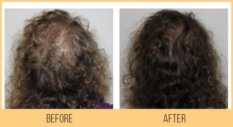 Keravive_BeforeAfter_Female01