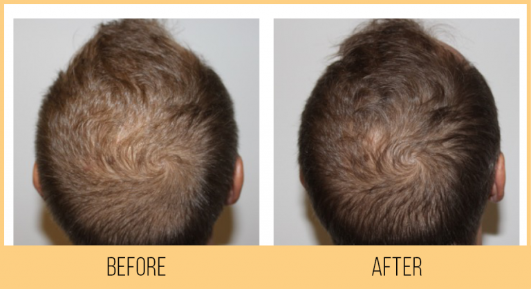 Keravive_BeforeAfter_Male01